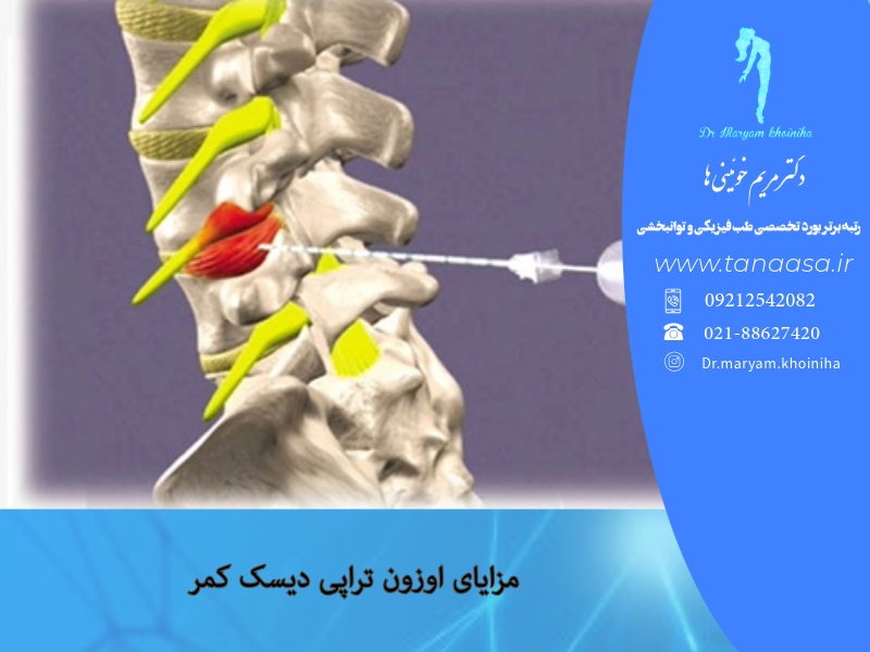 مزایای اوزون تراپی دیسک کمر