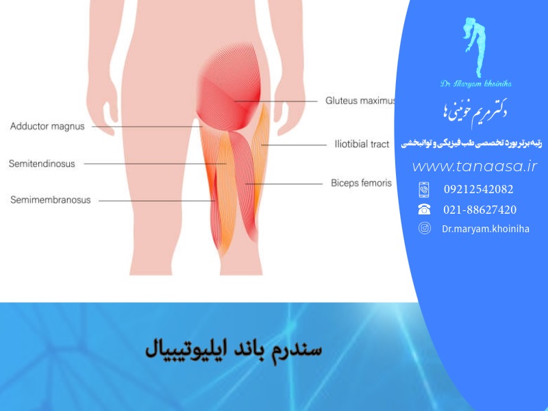 سندرم باند ایلیوتیبیال